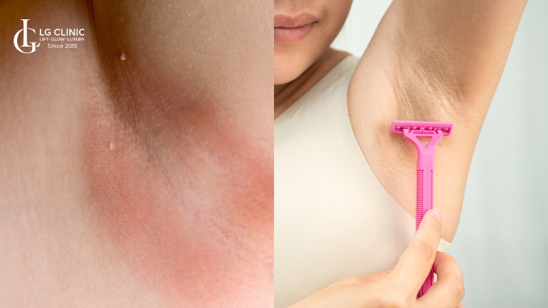 nách bị ngứa rát