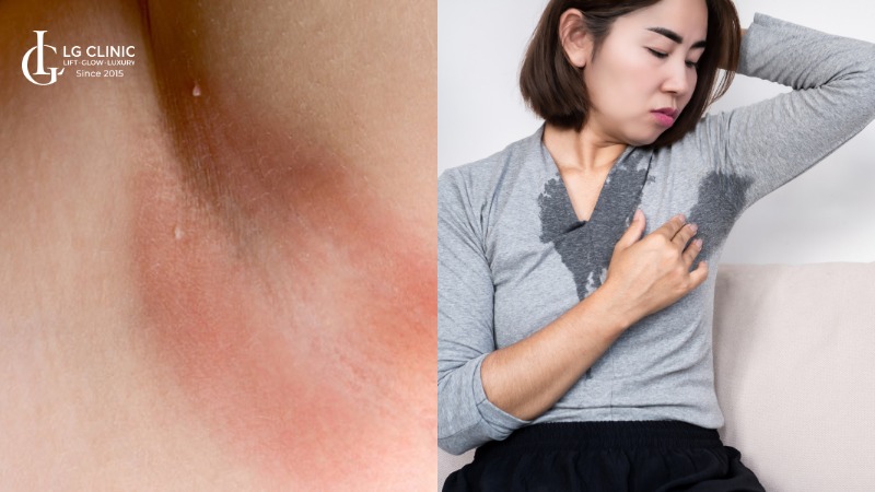 nách bị ngứa rát