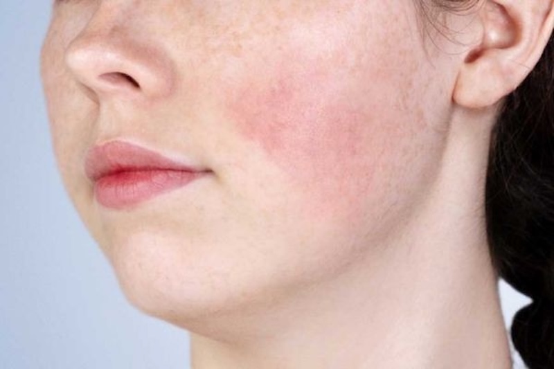 tác hại của nâng cơ hifu