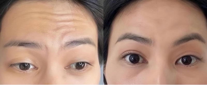xoá nếp nhăn trên trán