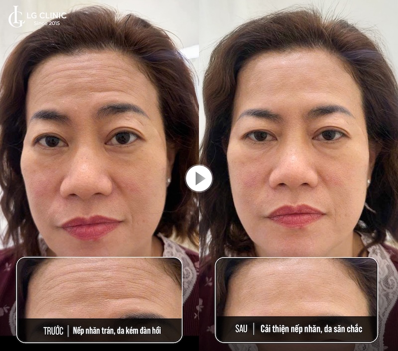 xoá nếp nhăn trán