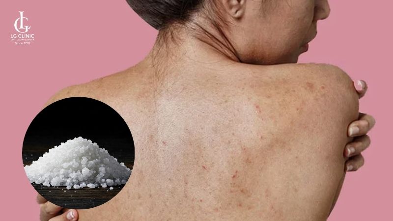 cách trị mụn lưng bằng muối