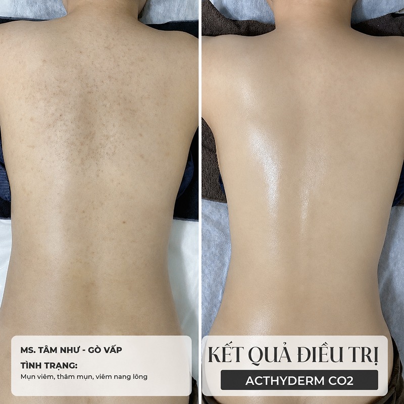 cách trị mụn lưng bằng muối