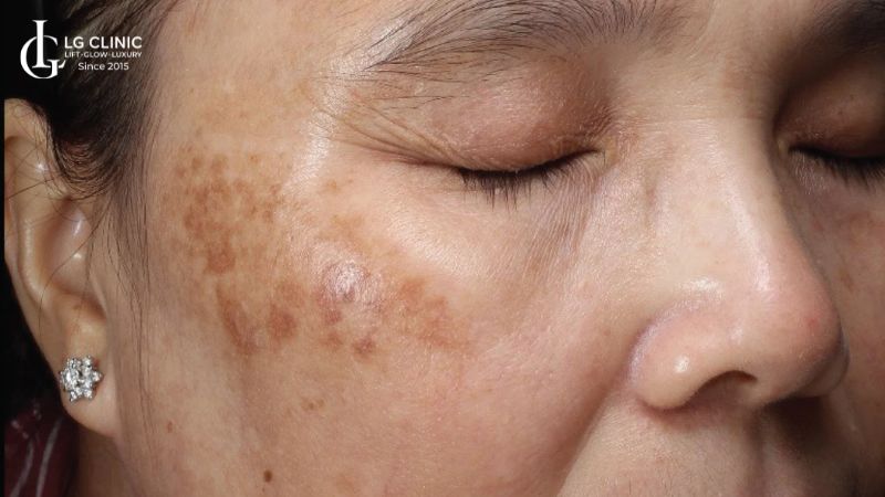 cách trị nám bằng vitamin E