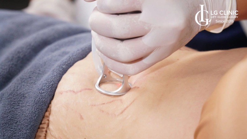 cách trị rạn da sau sinh