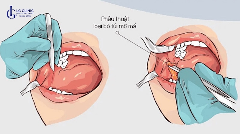 cách giảm mỡ má