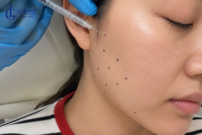 cách giảm mỡ má