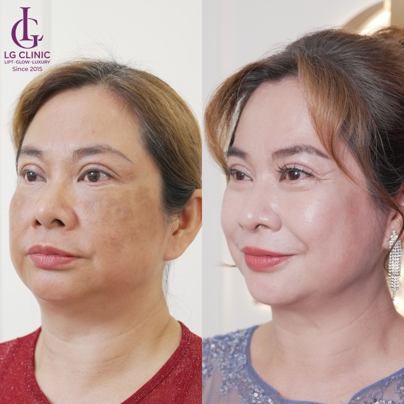 cách trị nám bằng nha đam