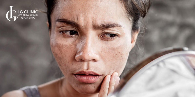 cách trị nám bằng nha đam