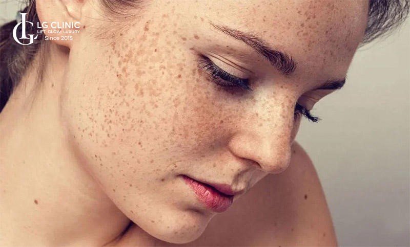 cách trị nám bằng nha đam