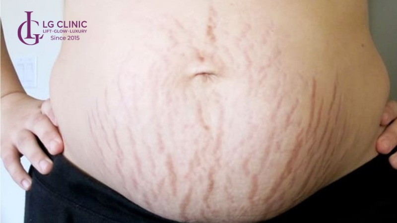 cách trị rạn da cho bà bầu