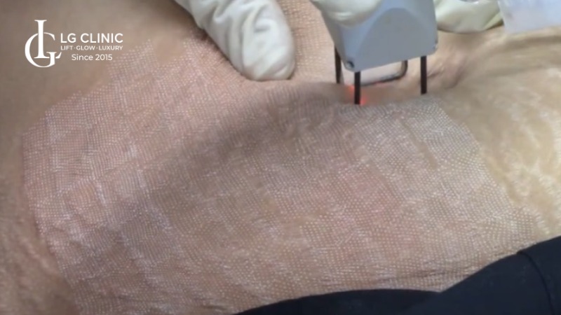 cách trị rạn da cho bà bầu