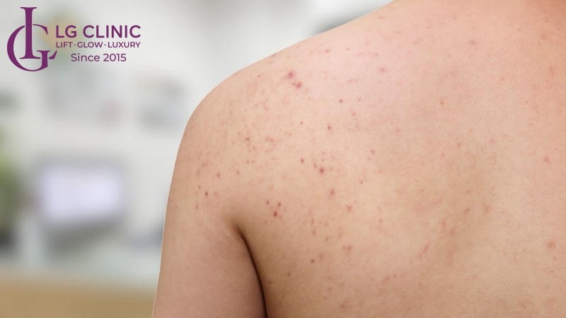 Cách trị thâm mụn bằng lá chè xanh tại nhà