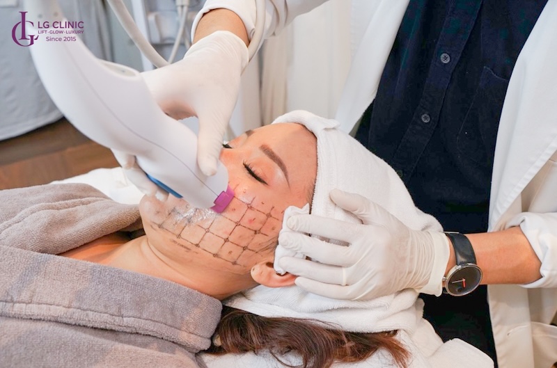 nâng cơ bằng thermage