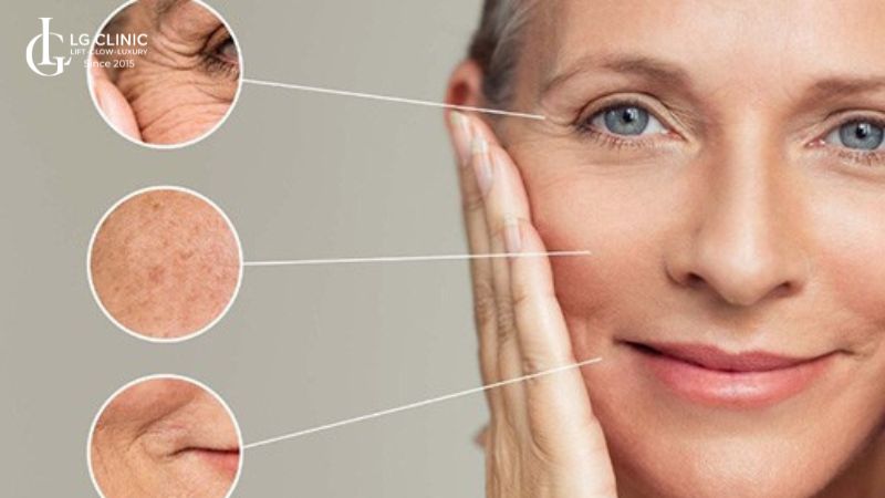 Da chảy xệ biểu hiện rõ nhất ở vùng mí mắt cũng như khóa miệng