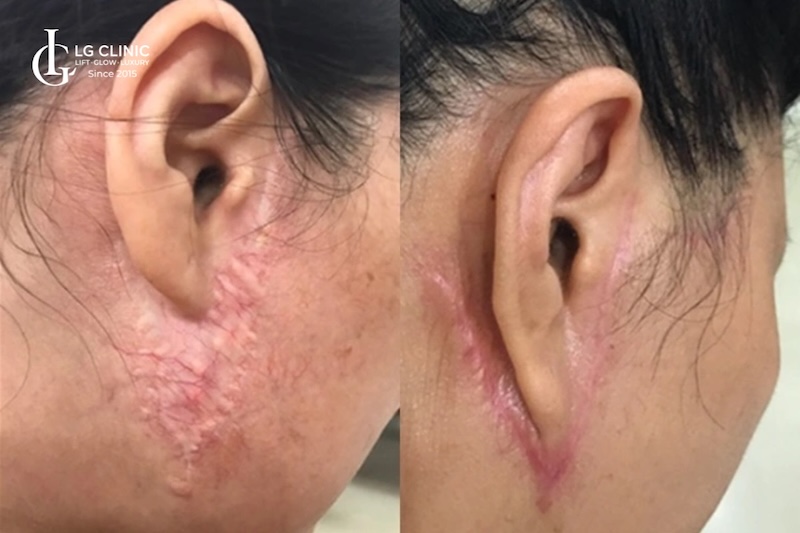 cách khắc phục da chảy xệ