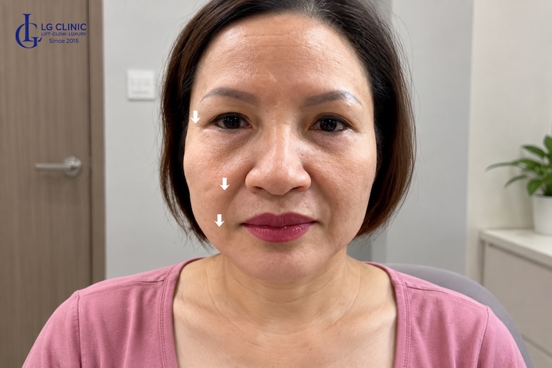 da mặt chảy xệ