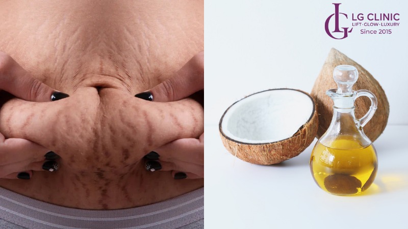 Dầu dừa có trị rạn da không