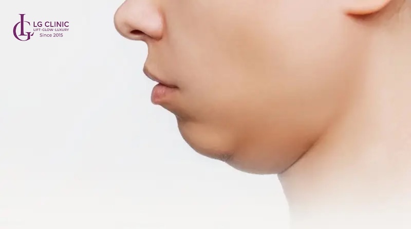 nọng cằm