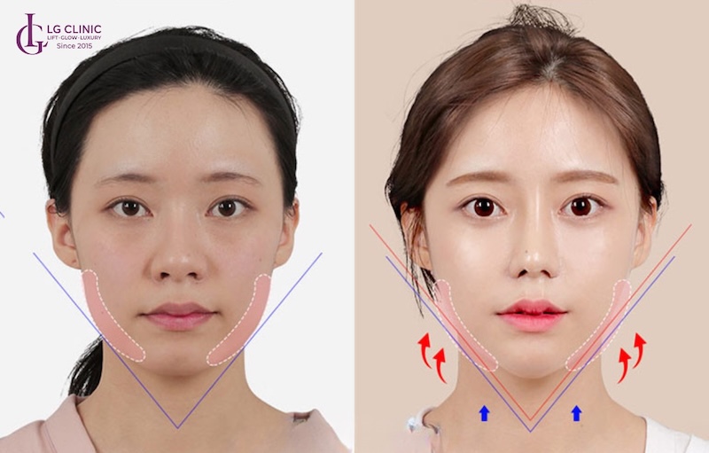 Phẫu thuật gọt xương hàm