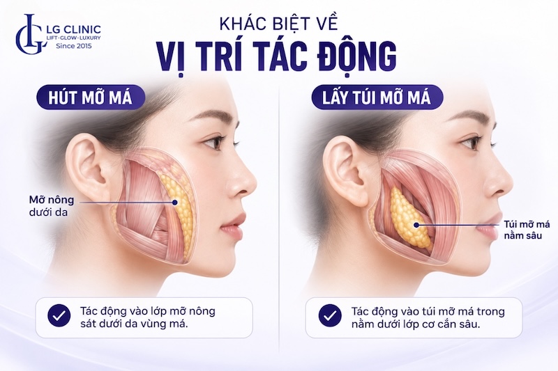 hút mỡ má và lấy túi mỡ má