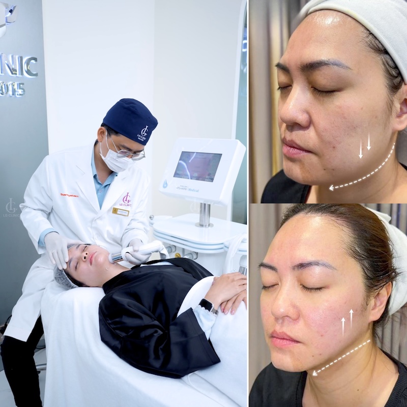 giảm mỡ má không xâm lấn