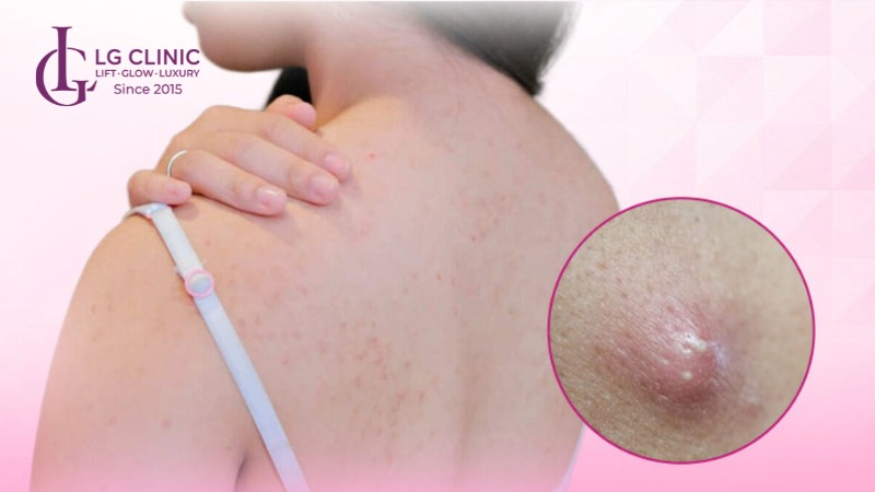 mụn mủ ở lưng