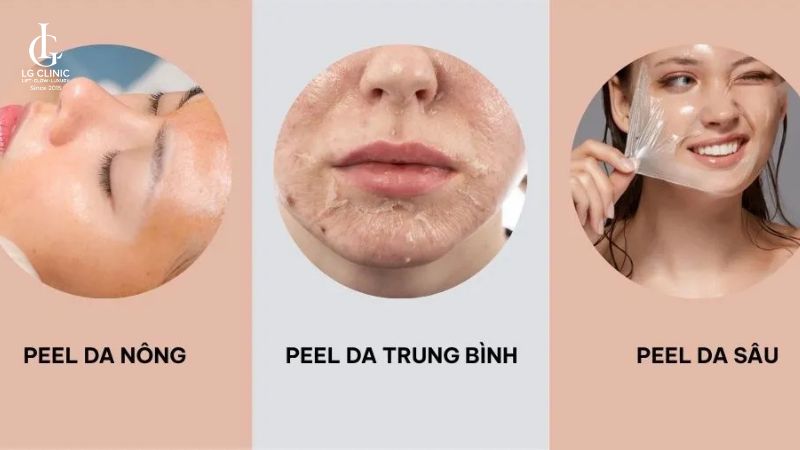 sau laser bao lâu được peel da