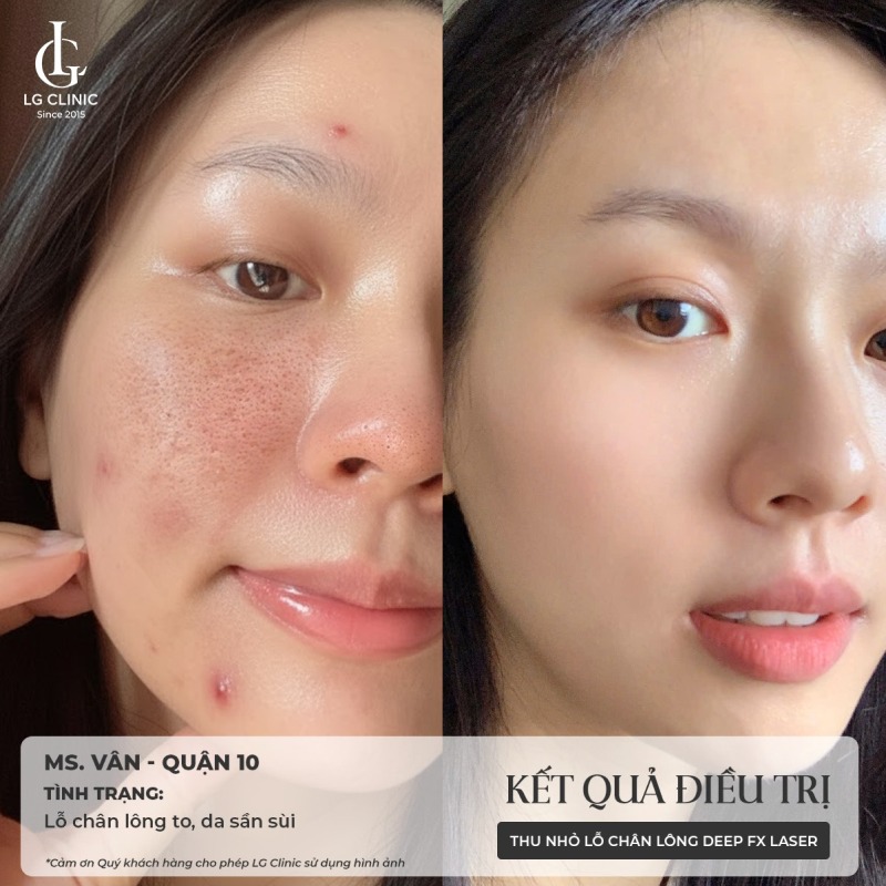 Spa thu nhỏ lỗ chân lông Phú Nhuận