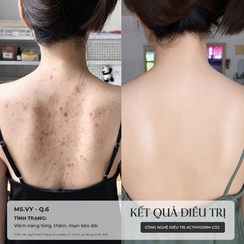 spa trị mụn lưng phú nhuận