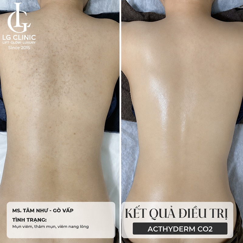 Spa trị mụn lưng quận 1
