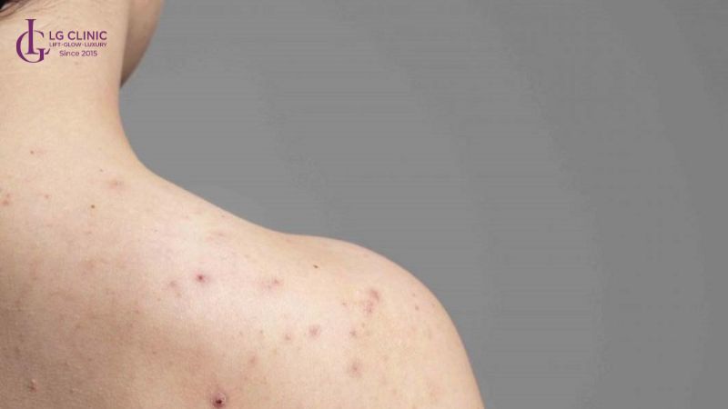 tác hại của tắm trắng bằng cám gạo