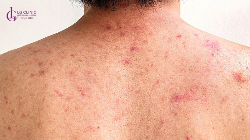 cách trị mụn lưng bằng bột đậu đỏ