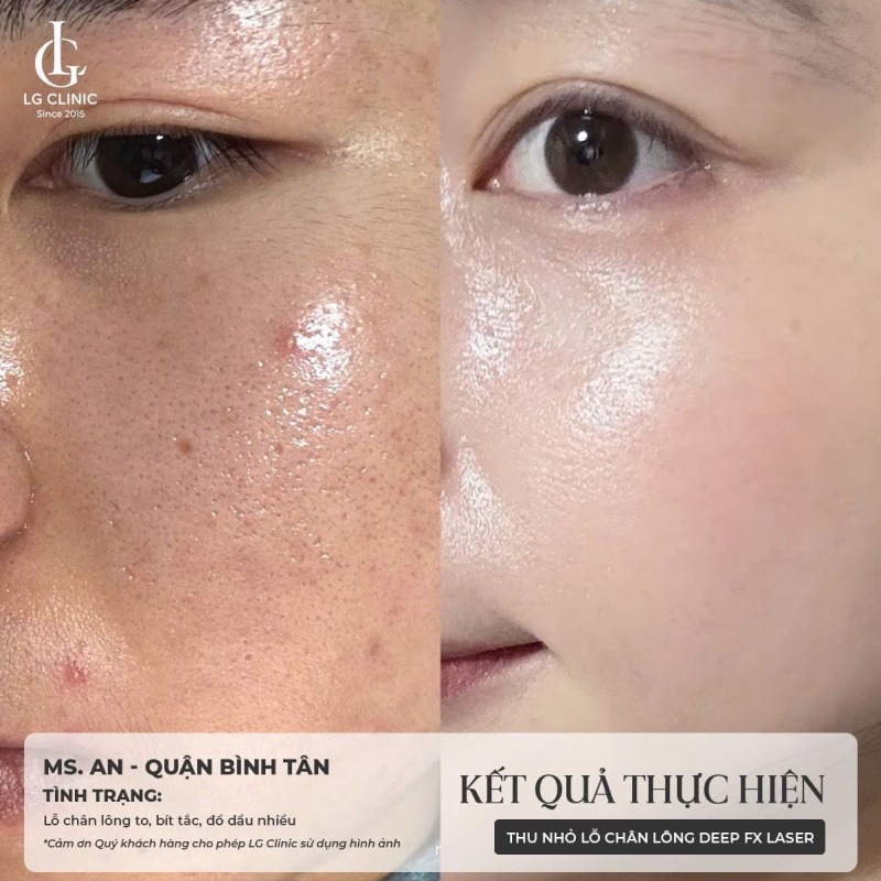 Triệt lông mặt có thu nhỏ lỗ chân lông không