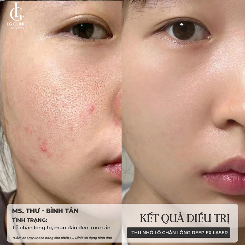 Triệt lông mặt có thu nhỏ lỗ chân lông không