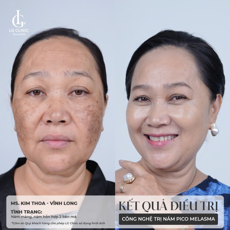 cách đắp mặt nạ tinh bột nghệ trị nám