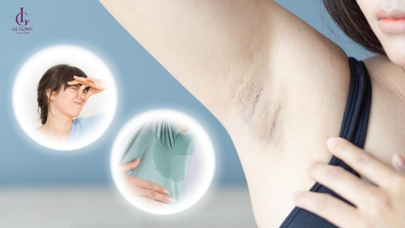 cách để không bị chảy mồ hôi nách