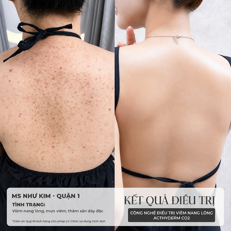cách trị mụn lưng khi mang thai