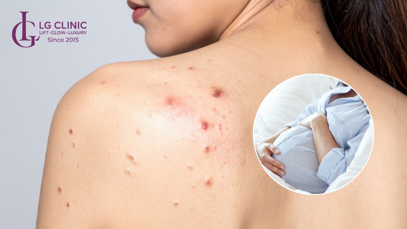 cách trị mụn lưng khi mang thai