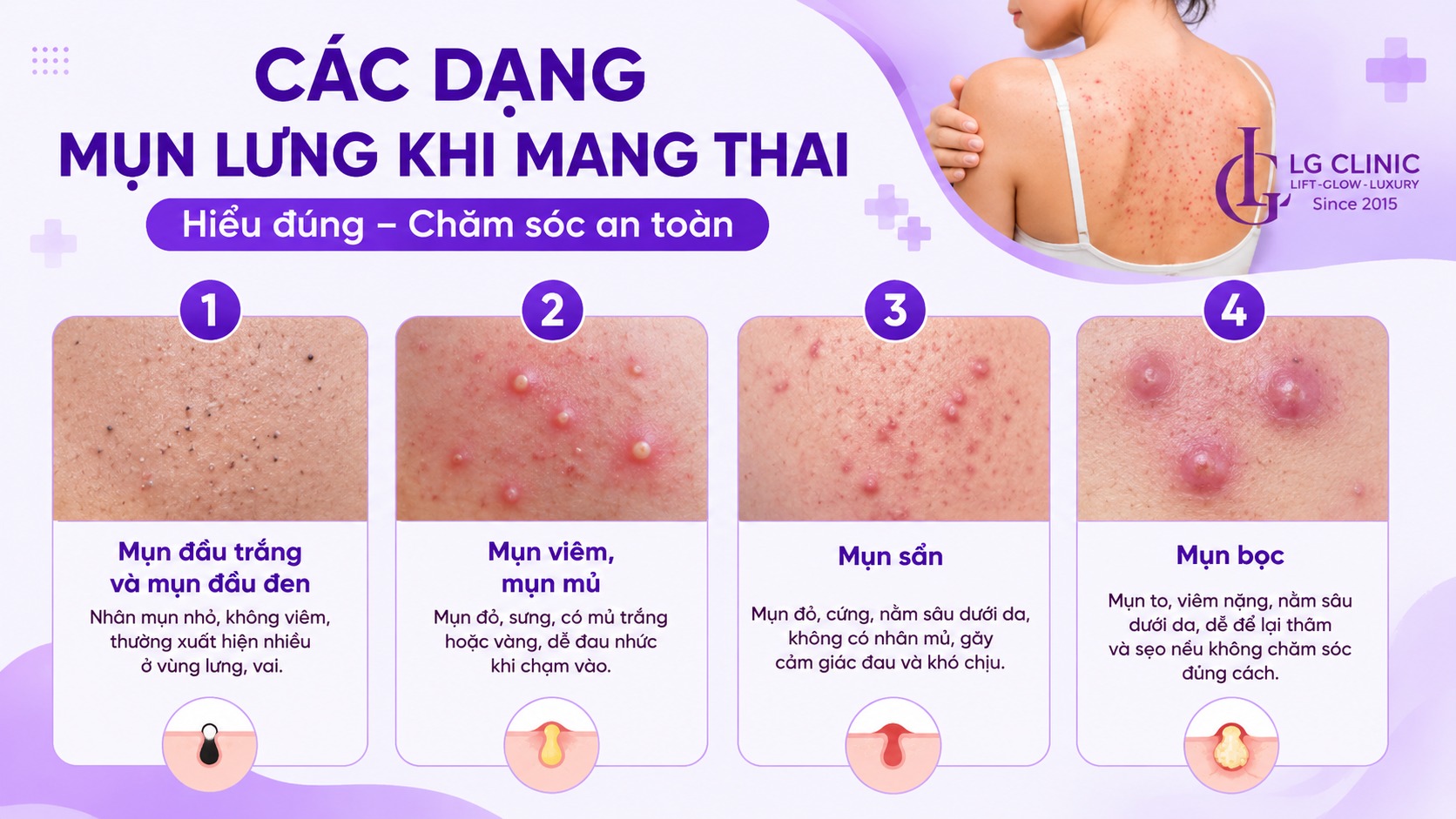 cách trị mụn lưng khi mang thai