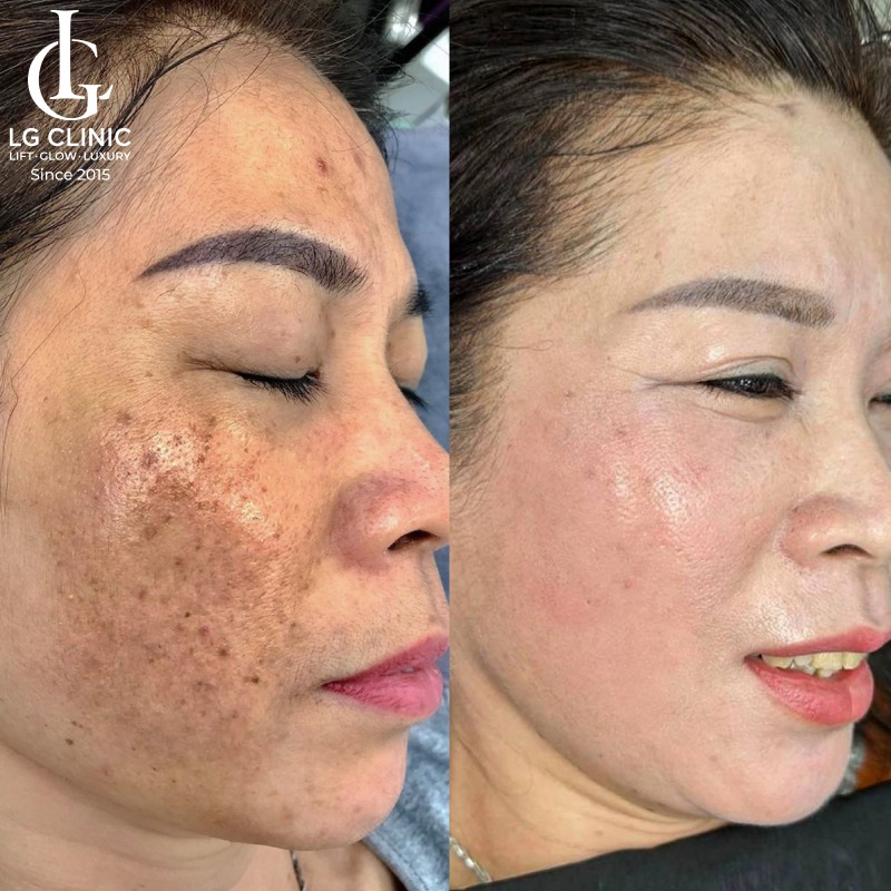 Cách trị nám bằng lá tía tô tại nhà