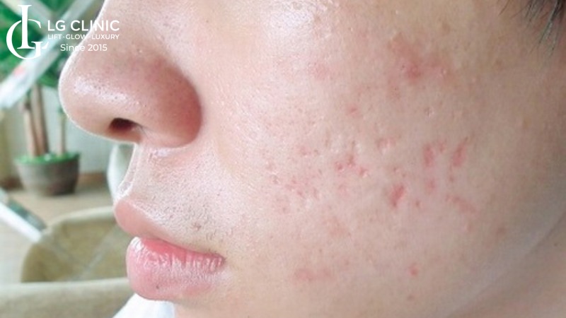 Cách trị sẹo thâm thủy đậu