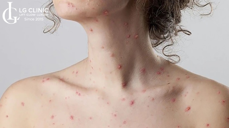 Cách trị sẹo thâm thủy đậu