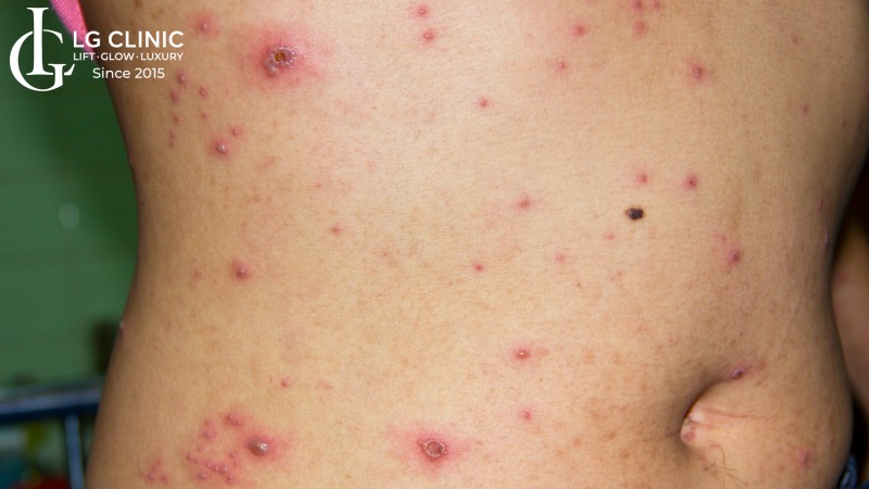 Cách trị sẹo thâm thủy đậu