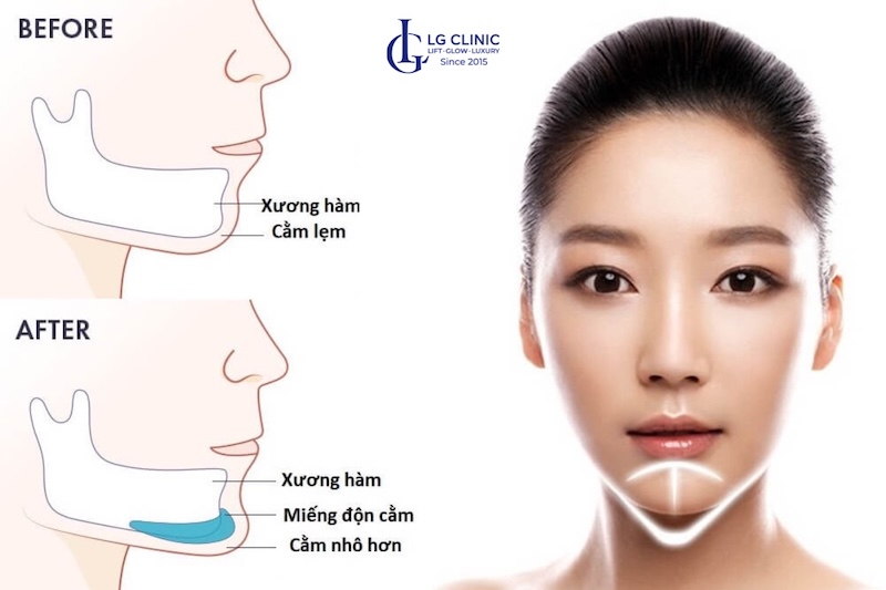 cách làm cho cằm dài hơn