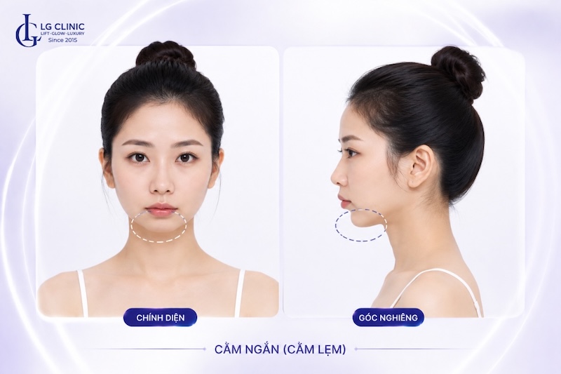 cằm ngắn