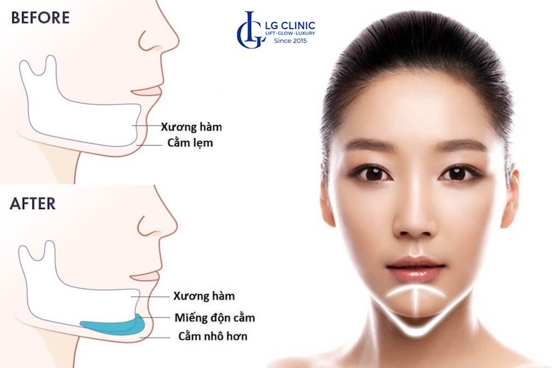 cách làm cằm thon gọn