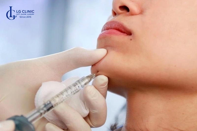 cách làm cằm thon gọn