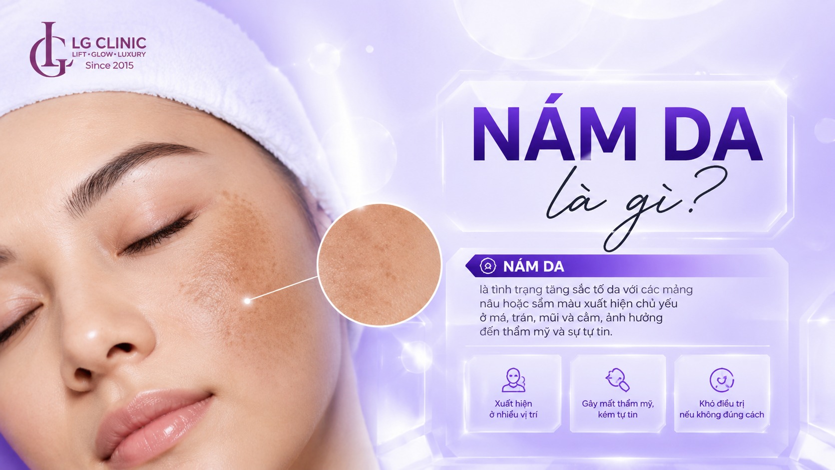 Có nên dùng kem trị nám không