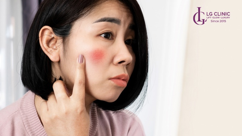 Có nên dùng kem trị nám không